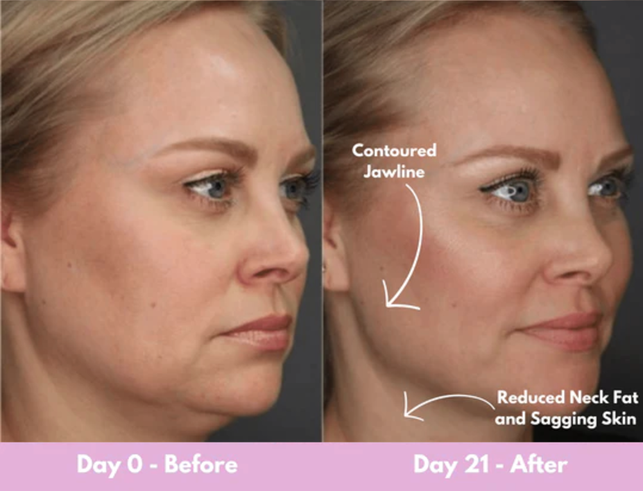 21 days results facial sculptor 1